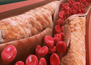 چگونه چربی خون می‌تواند بر سطح قند خون تاثیر بگذارد 