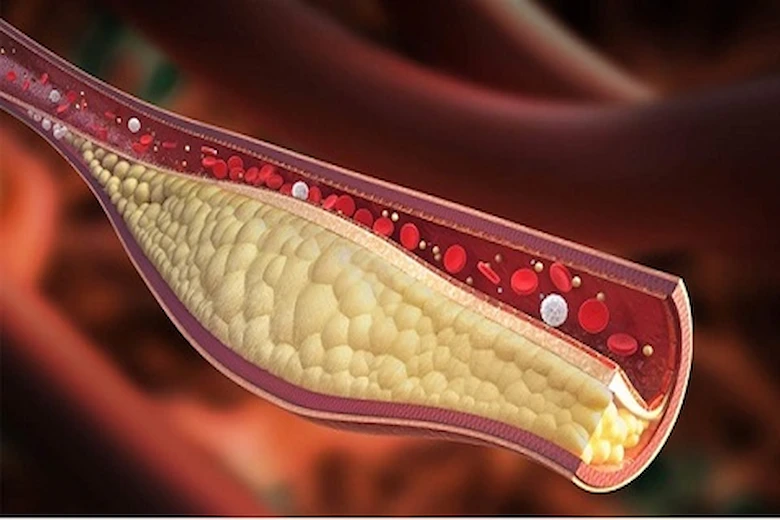 تصویری از چربی خون بالا