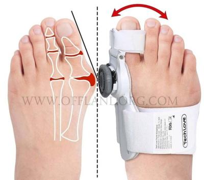 Rib hallux valgus